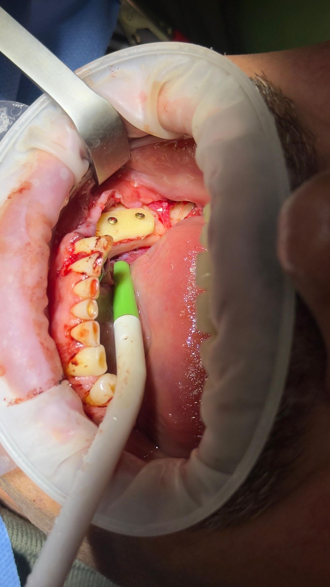 Chirurgie dento-alveolară — caz complex