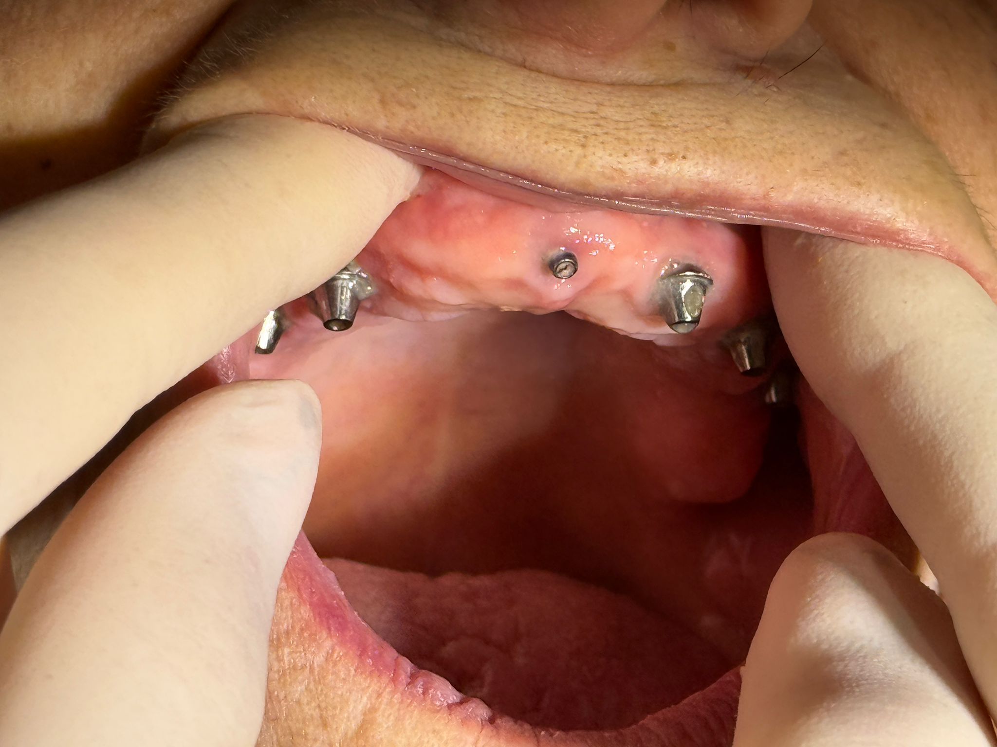 Implant dentar — faza postoperatorie