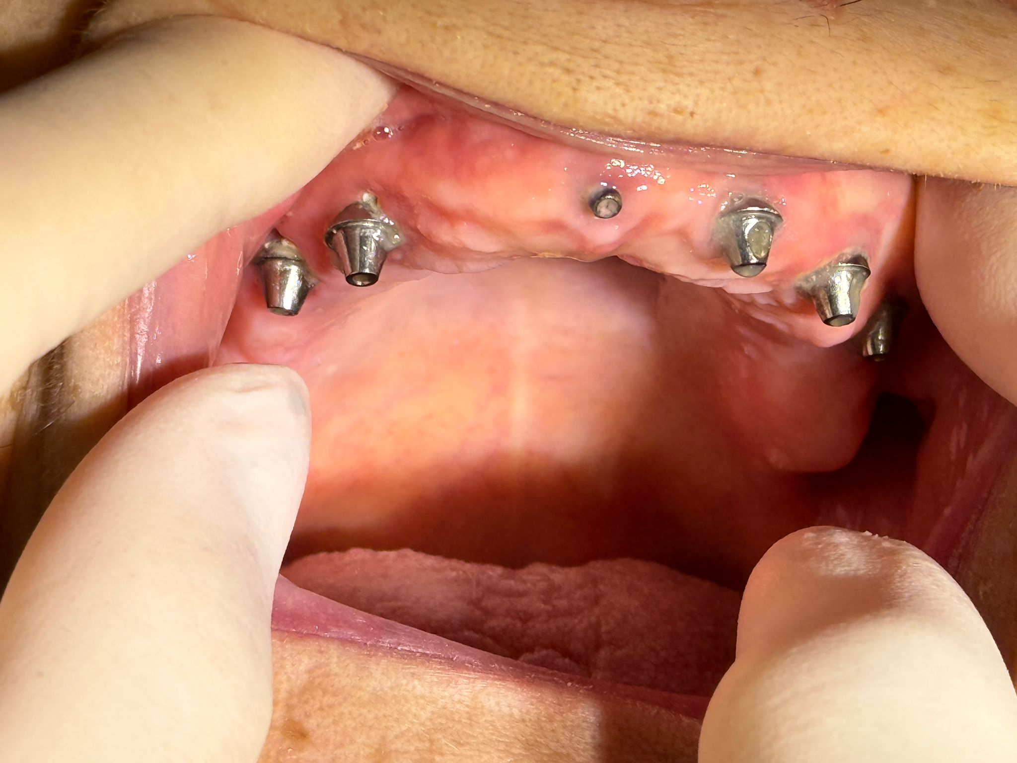 Implant dentar complet