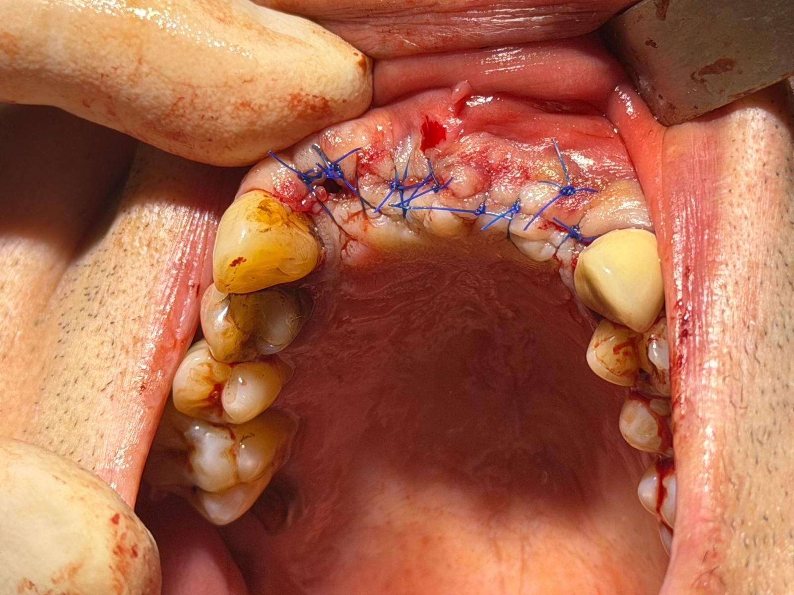 Augmentare buze — before & after