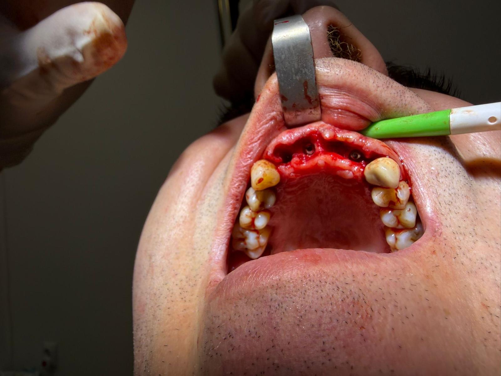 Tratament Botox — riduri periorale