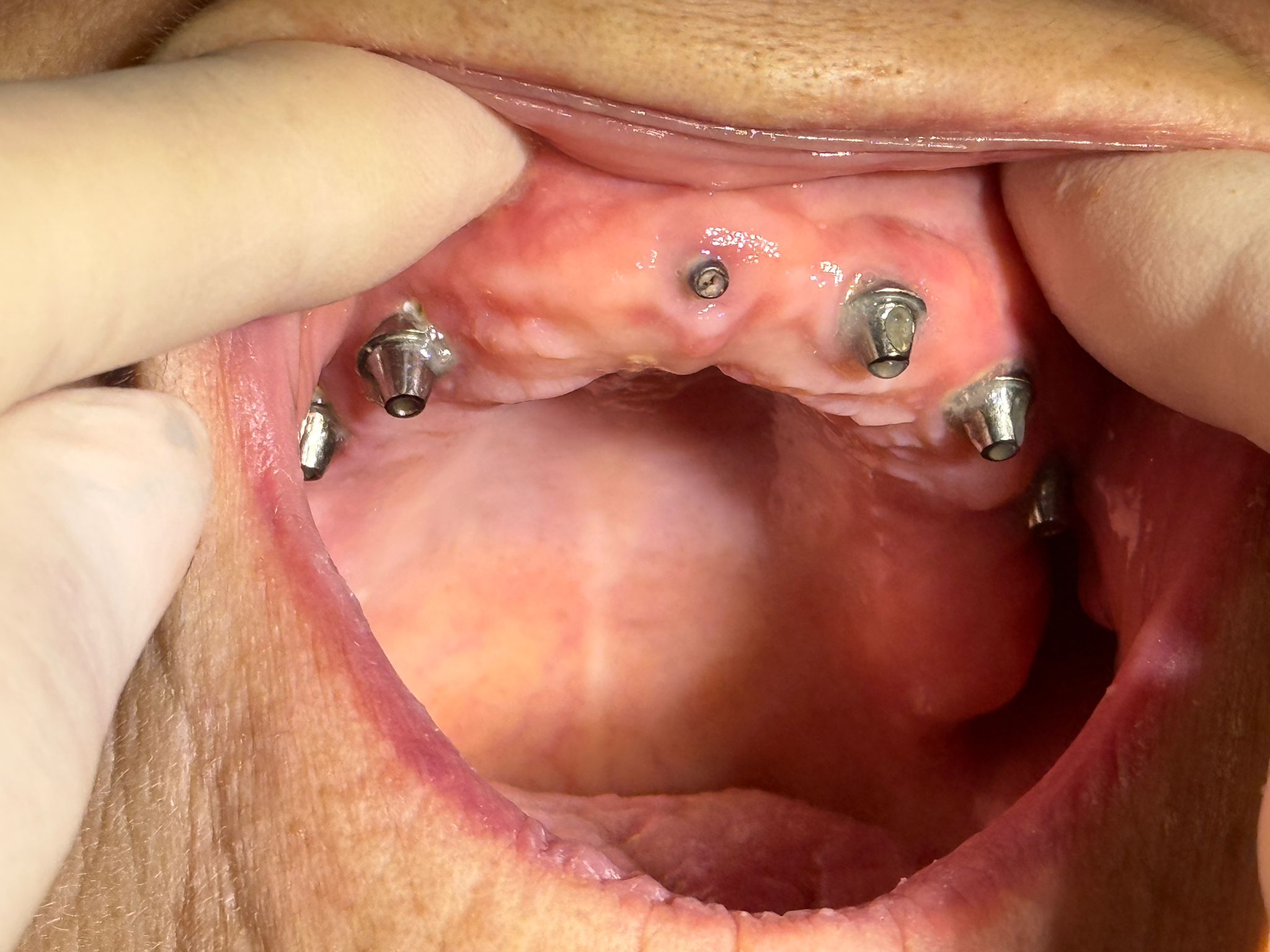 Implanturi dentare superioare — result postoperator