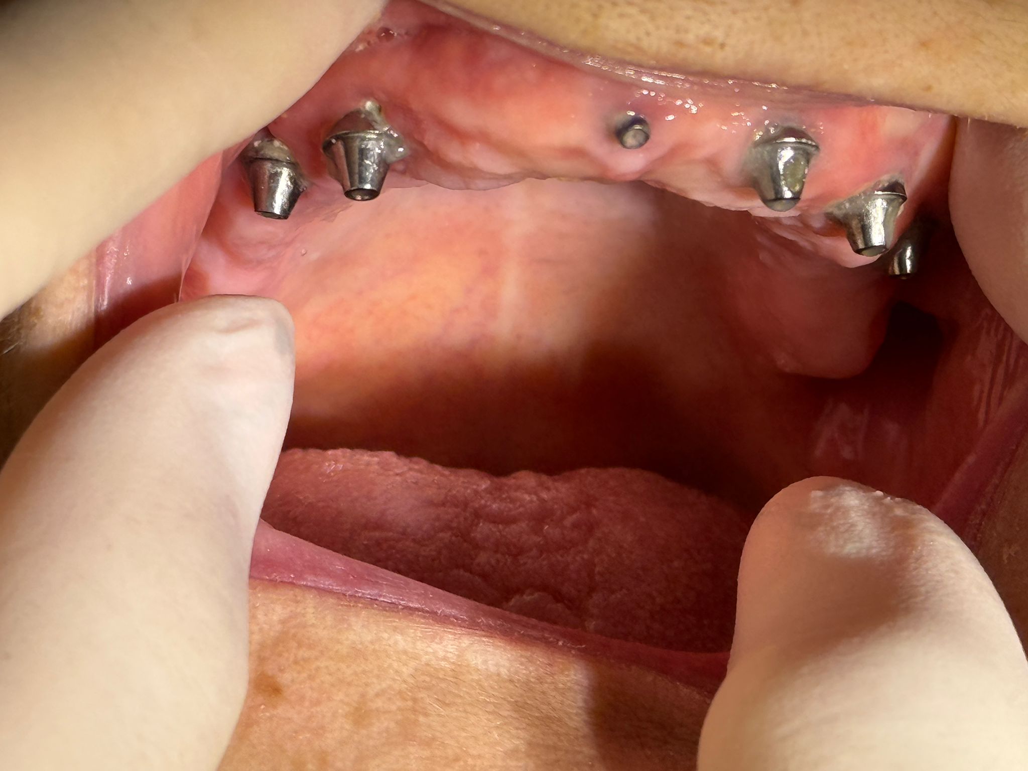 Implanturi dentare multiple — vedere laterală